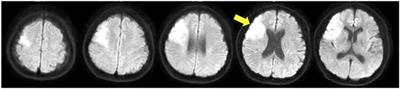 Effect of bihemispheric transcranial direct current stimulation on distal upper limb function and corticospinal tract excitability in a patient with subacute stroke: a case study